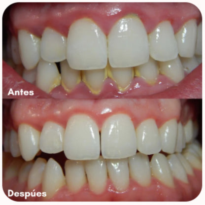 Oral Care ™ | Limpieza Dental